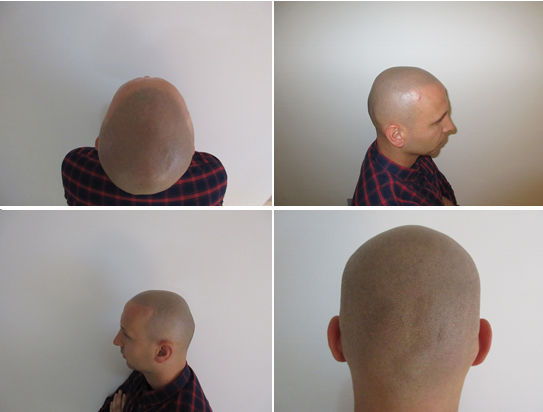 Have You Tried Scalp Micropigmentation
